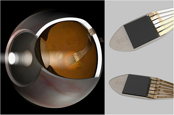 Ретинальная система Alpha AMS на сетчатке