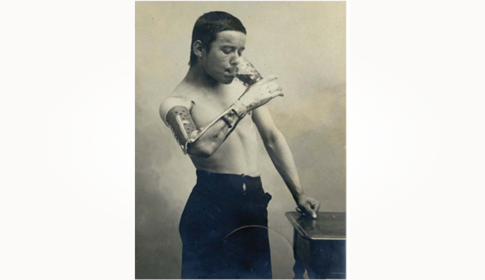 Функциональный протез начала XX века, управляемый мышцами.